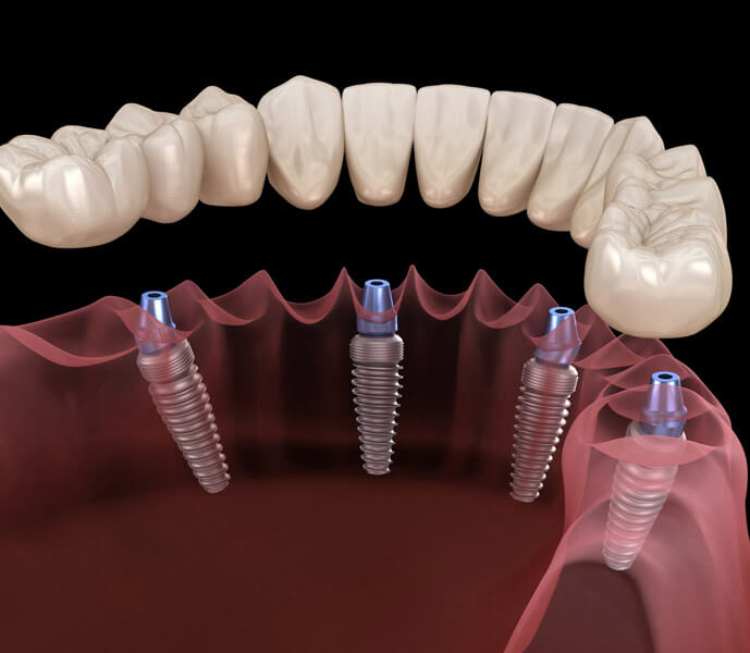 all on four dental implant Turkey