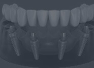 Dental Implants,All on Four