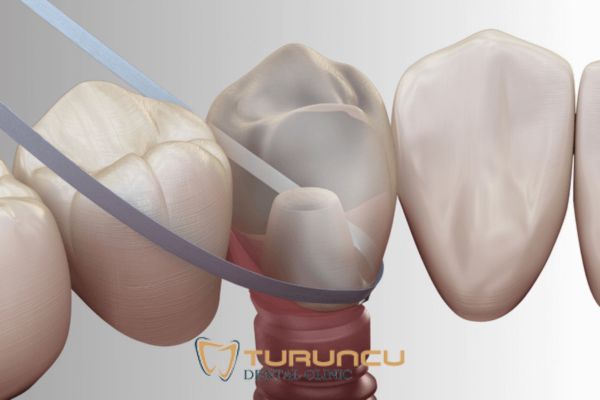 Tek diş implant ile diş ipi kullanımı Antalya