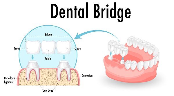 köprü mü implant mı?