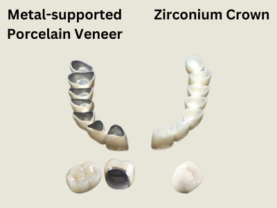 Metal-supported Porcelain Veneer or Zirconium Crown