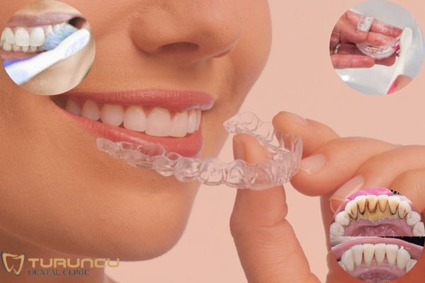 Evde diş plağı temizliği nasıl yapılır? Şeffaf diş plağı temizliği nasıl yapılır? Antalya