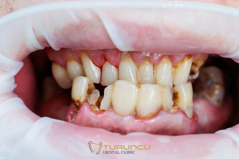 turuncu dental tooth decay