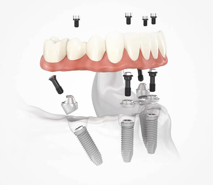 What is all-on-4 dental implants in Turkey?