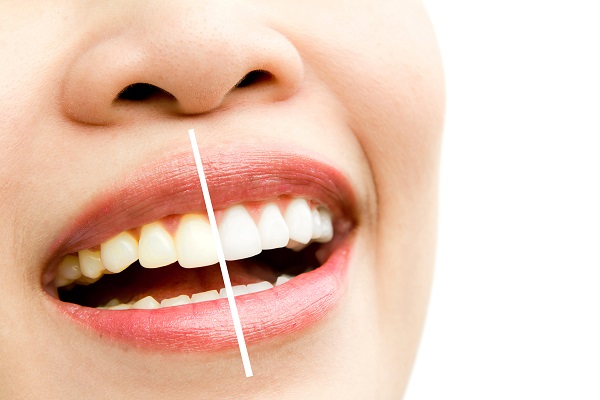 Teeth Whitening Bleaching in Turkey, Antalya