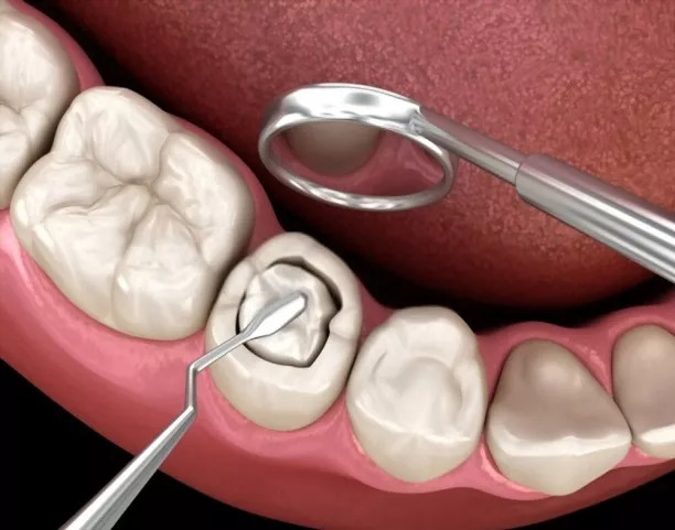 Tooth Filling in Turkey, Composite Filling