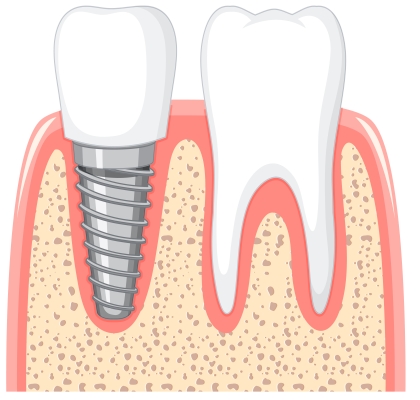 dental implant in turkey