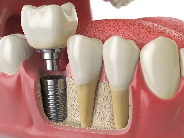 dental implant in turkey