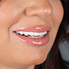 Dental Veneers-Turuncu Dental Clinic Antalya, Turkey