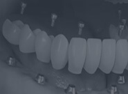 Dental Implants,All on Four,All on Six