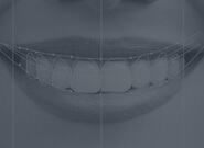 Gülüş Tasarımı-Lamine Diş-Gülüş Estetiği