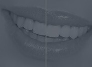 Teeth Whitening,Brighter Smile Options and Cost-Turkey